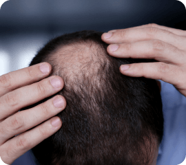 StaminUp hair thinning testosterone loss